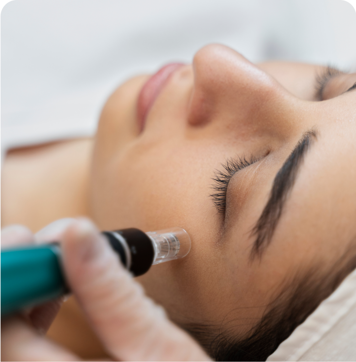Skinpen Microneedling